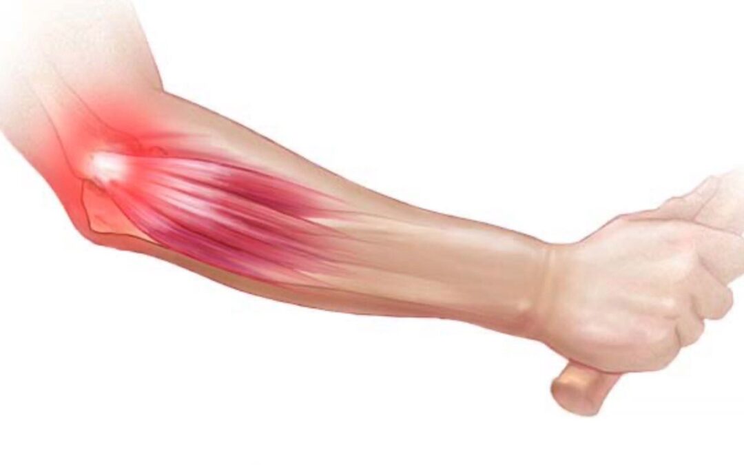 What Causes A Tennis Elbow In Pickleball? 5 Important steps to prevent it